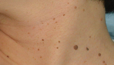 Memahami Siklus Pertumbuhan Epidermis: Mengapa Papiloma Muncul dan Bagaimana Mengatasinya?