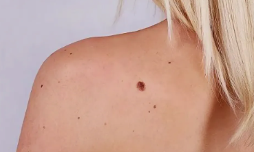 Memahami Siklus Pertumbuhan Epidermis: Mengapa Papiloma Muncul dan Bagaimana Mengatasinya?